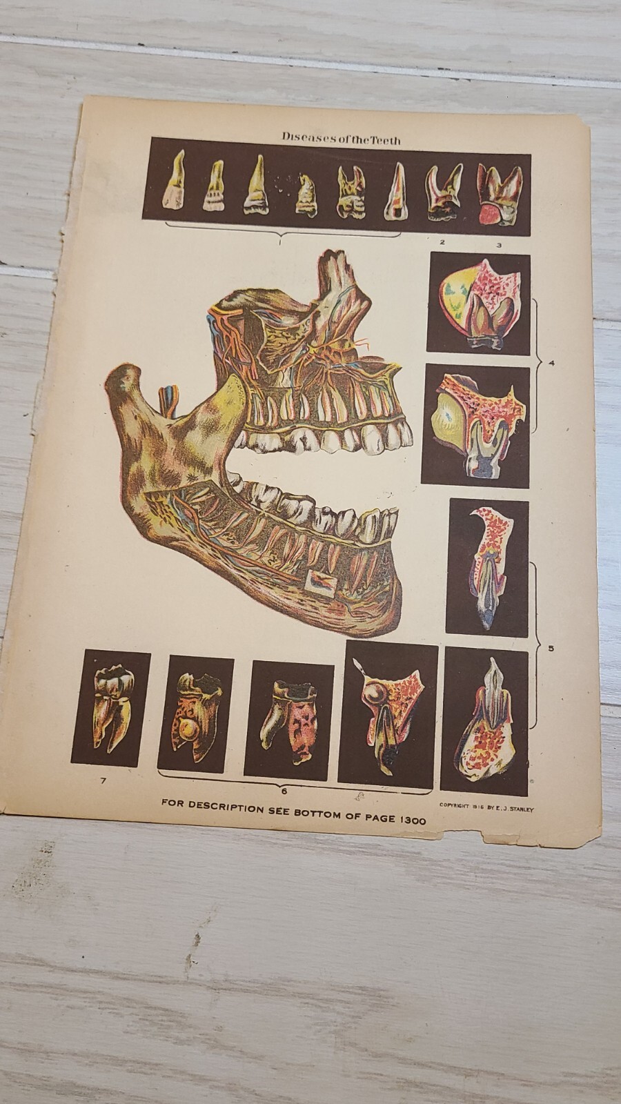 1916 E J Stanley ANTIQUE MEDICAL Anatomy Chart Diseases Of The Teeth 9.75x7
