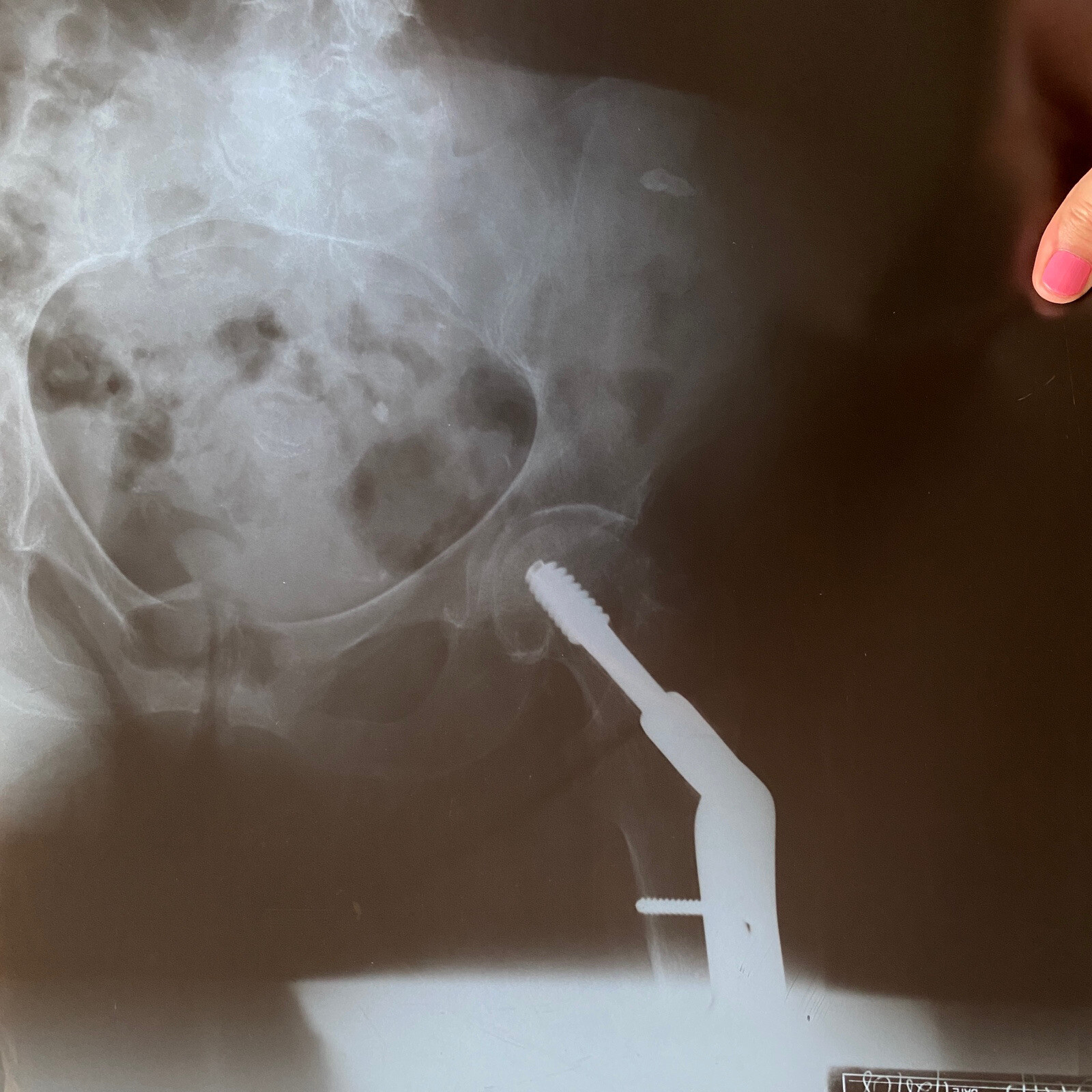 Real X-Ray Hips Leg Spine Film Sheet Rod Screw for Education Art 14x17 Inches