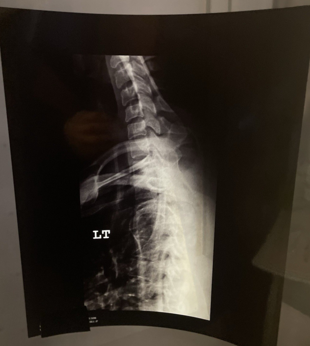 Medical X-Ray Film Student Education Physician Spine Spinal Neck Back 17" x 14"