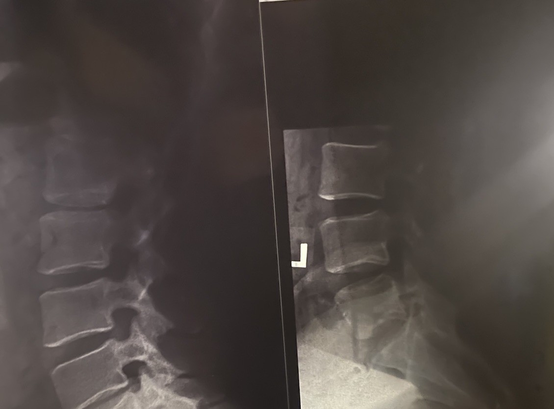 Medical X-Ray Film Student Education Physician Spine Spinal Neck Skull 17" x 14"