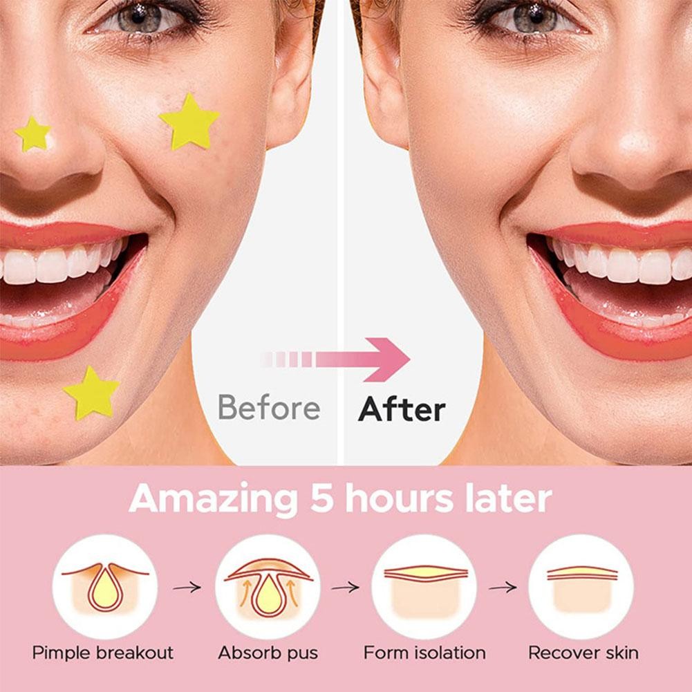 600Pcs/Set Star Pimple Patch Acne Colorful Invisible H2B3 Care Removal Acne R3P3