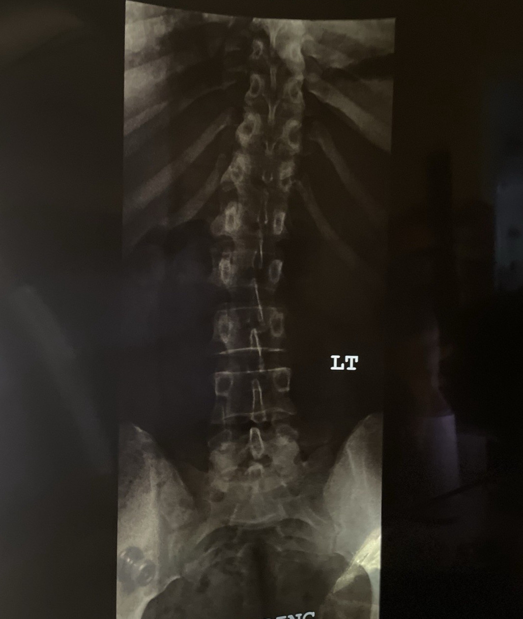 Medical X-Ray Film Student Education Physician Spine Spinal Back Hips 17" x 14"